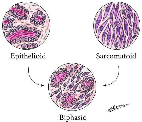 Mesothelioma-types