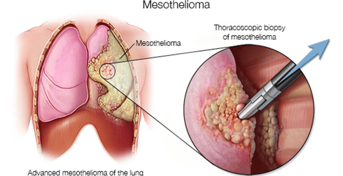 Mesothelioma