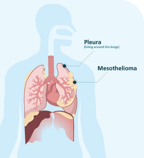 What-You-Should-Know-About-Mesothelioma-in-2020a