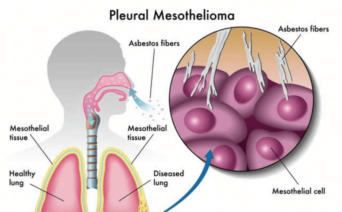 Mesothelioma