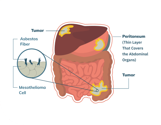 Mesothelioma stages