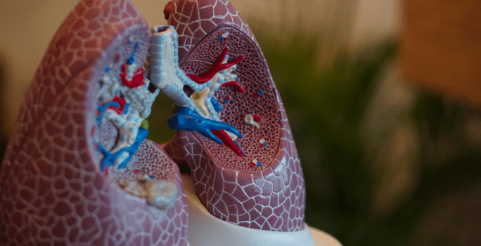 Lung cancer