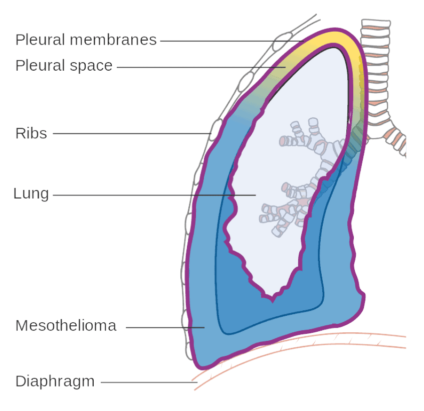 Stage-3-Mesothelioma