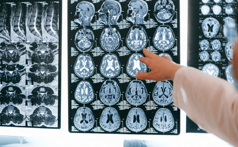 a doctor pointing at an X-ray of a brain