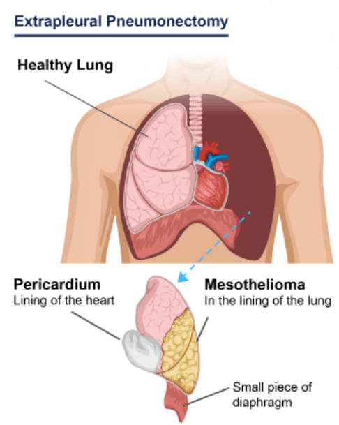 extrapleural-pneumonectomy-mobile