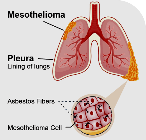 pleural-mesothelioma