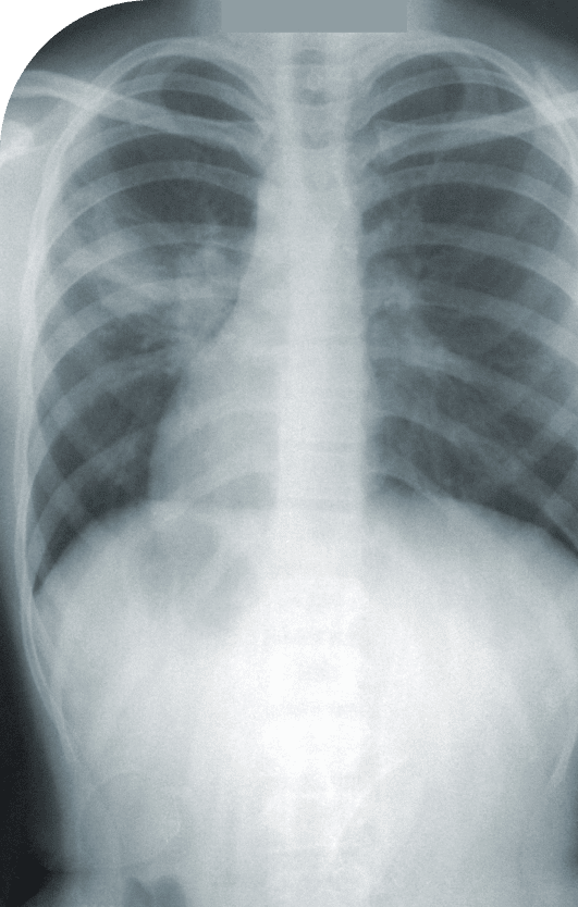 chest x-ray