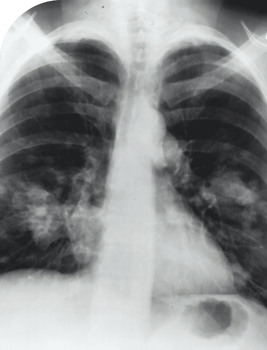 chest x-ray