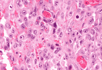Mesothelioma Epithelioid Cells