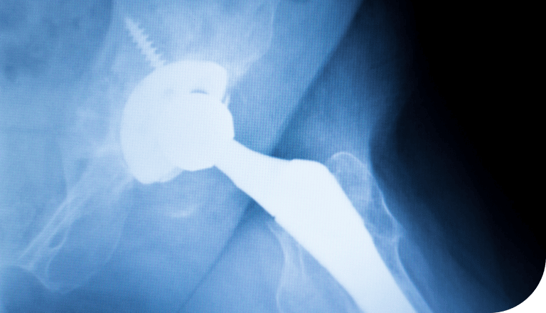 hip implant