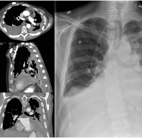 chest x-ray