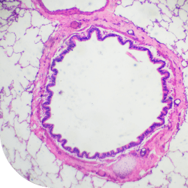 Lung biopsy