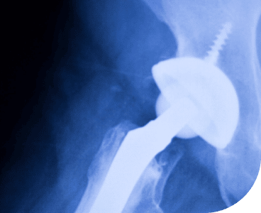 exactech implant