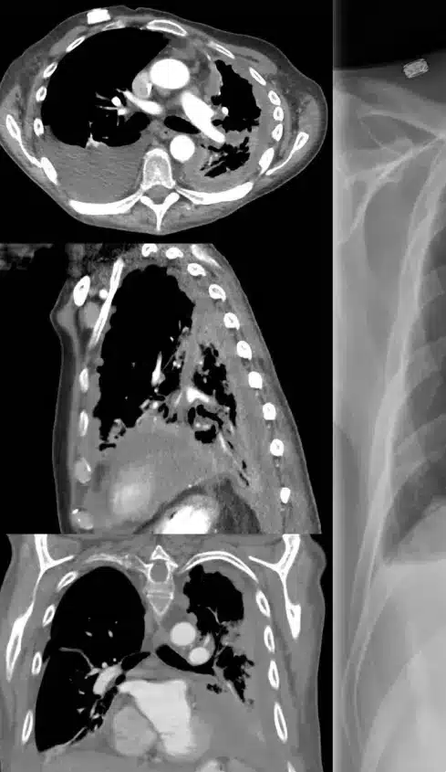 MRI from a Louisiana hospital showing mesothelioma in a patient