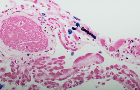 Mesothelioma cells under a microscope