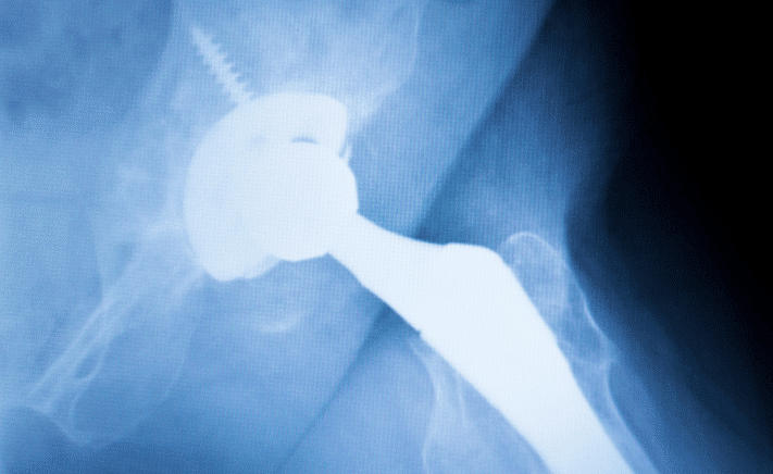 X-Ray showing DePuy hip replacement that was subjected to a lawsuit and litigation