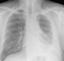 Chest X-ray of asbestos exposure