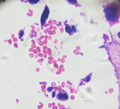Choriocarcinoma Under a Microscope