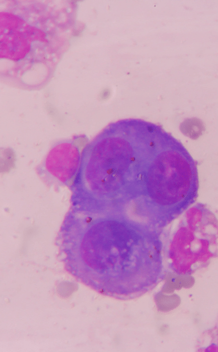 Mesothelioma under microscope