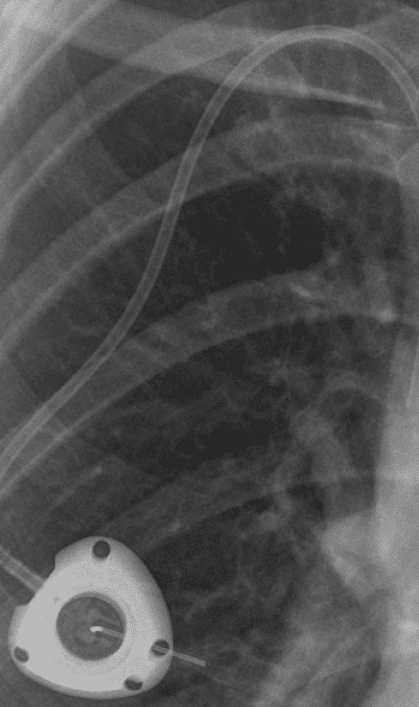 X-ray showing the Bard PowerPort device