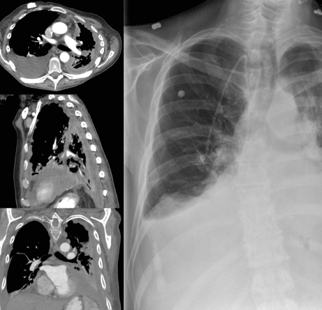 chest x-ray showing mesothelioma
