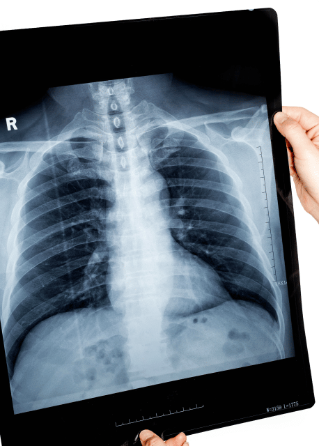 Chest x-ray from a construction worker exposed to asbestos who developed mesothelioma