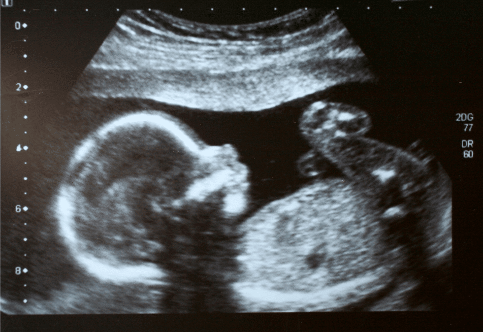Fetus on ultrasound image