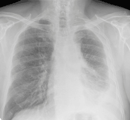 Chest X-Ray Showing Signs of Asbestos-Related Illness