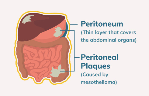 Infographic showing the peritoneum and peritoneal plaques
