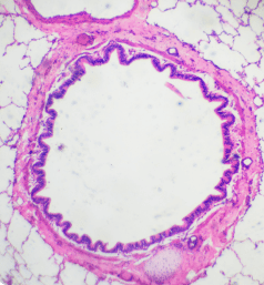 Results of a Lung Biopsy Under a Microscope