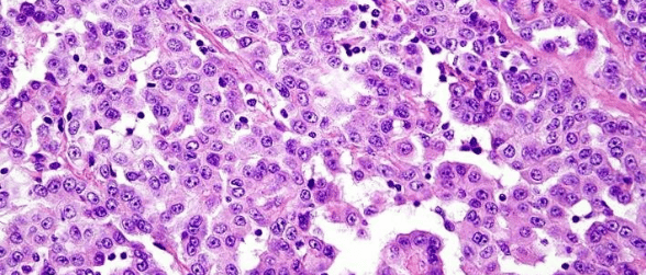 Malignant pleural mesothelioma cells