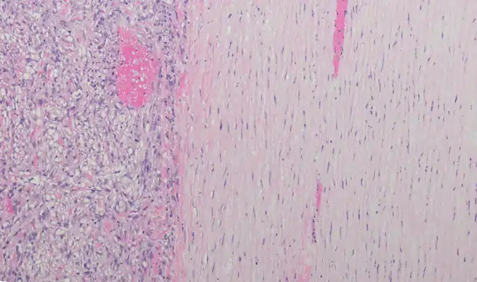 Sarcomatoid Mesothelioma Cancer Cells