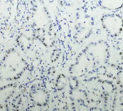 Peritoneal Mesothelioma Cancer Cells Under a Microscope