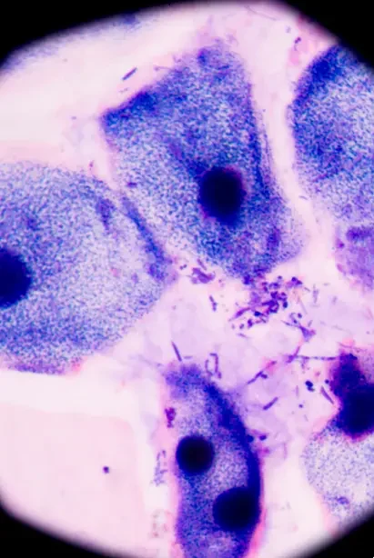 Magnified Epithelial Mesothelioma Cancer Cells Under Microscope