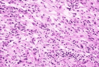 Sarcomatoid Mesothelioma Cancer Cells Under Microscope