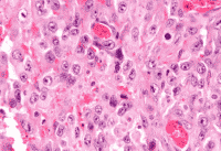 Epithelioid Mesothelioma Cells Under Microscope