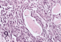 Biphasic Mesothelioma Cancer Cells Under Microscope