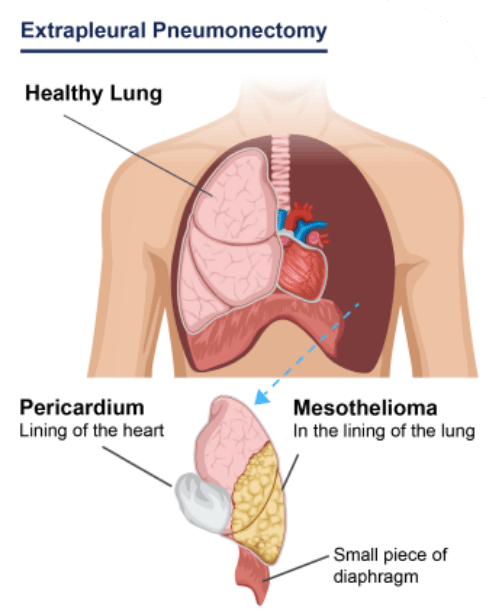 Infographic showing healthy and unhealthy lung