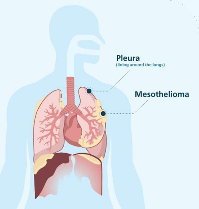 Infographic showing the location of the pleura and mesothelioma in the lungs