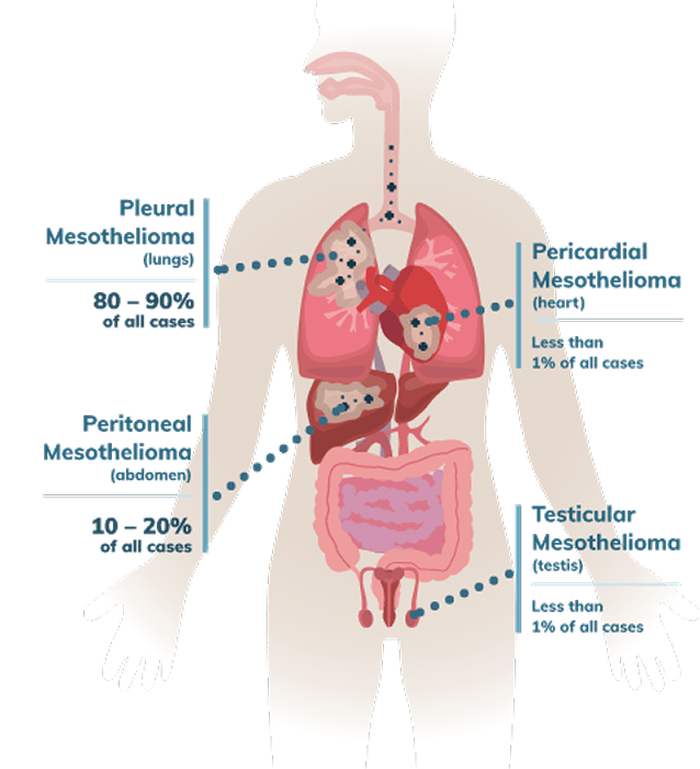 Infographic showing the types of mesothelioma with percentages for incidence rate