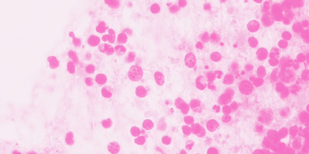 Mesothelioma Cancer Cells Under a Microscope