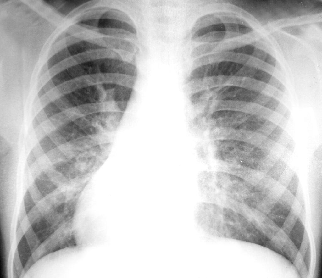 Chest X-ray Image of Pleural mesothelioma