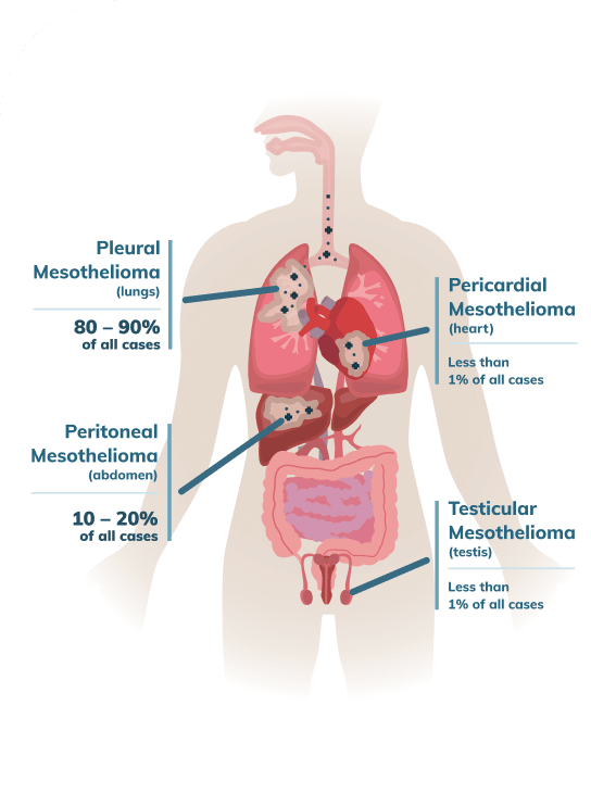 Infographic with different types of mesothelioma cells