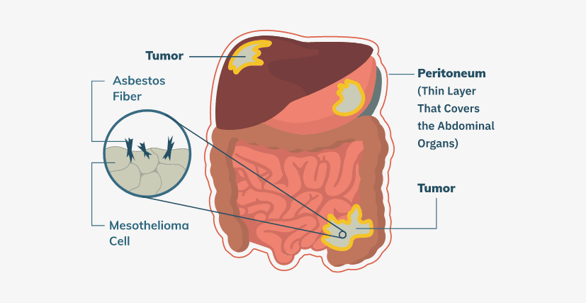 Infographic explaining peritoneal mesothelioma