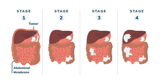 peritoneal mesothelioma stages