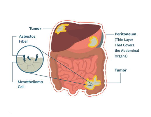 Infographic of peritoneal mesothelioma