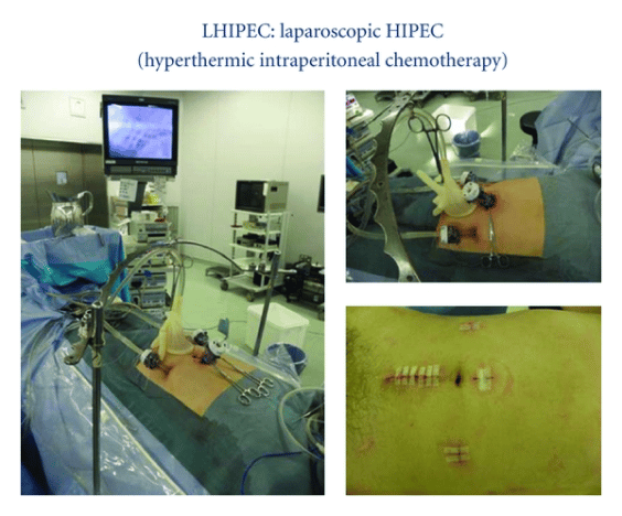 Images of patient undergoing hyperthermic intraperitoneal chemotherapy (HIPEC)
