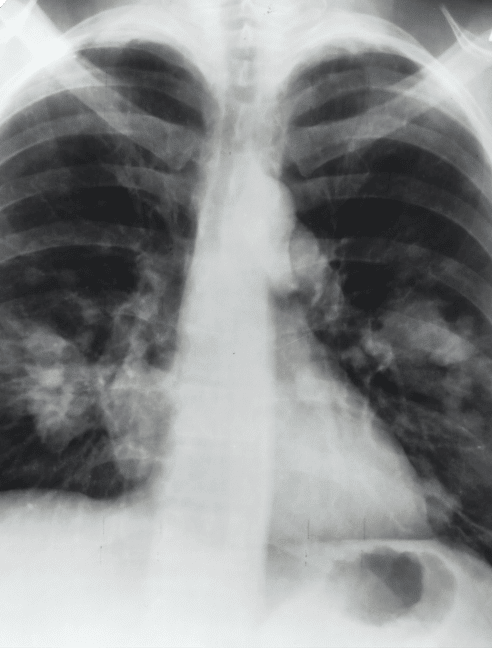 Chest X-ray