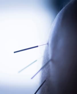 Acupuncture needles