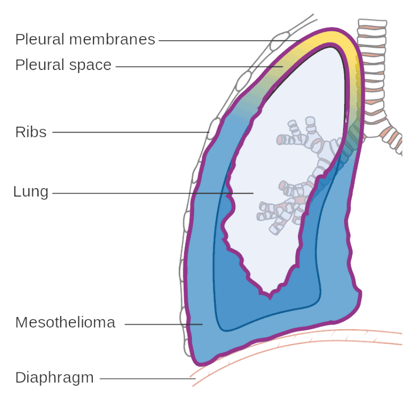 Plural mesothelioma stage 3 infographic